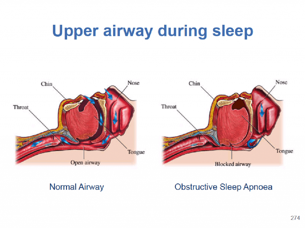 Snoring and Sleep Apnea