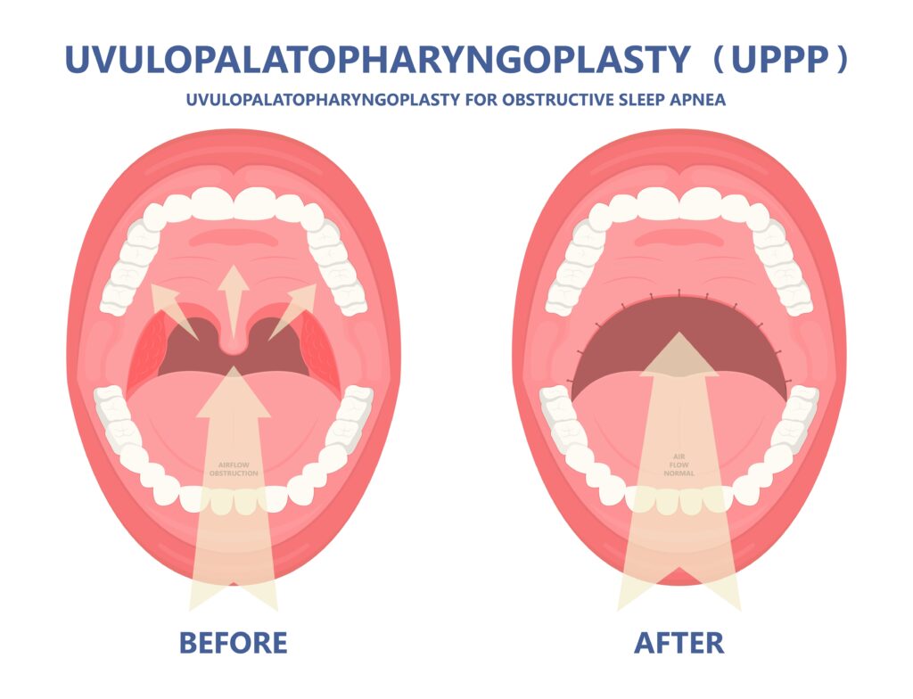 Snoring and Sleep Apnea